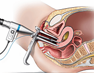 Hysteroscopy Procedure in Jalandhar