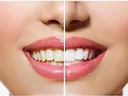 Laser Teeth Whitening Treatment - Dental Bleaching Services