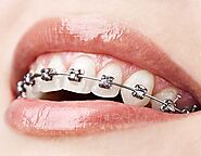Orthodontist | Teeth Braces and Aligners for Crooked Teeth