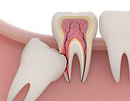 SDC | Wisdom Tooth Removal - Sainikpuri Dental Clinic Hyd