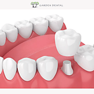 Avoid Tooth Pain with High-Quality Tooth Crown in Singapore | Garden Dental — Book Now!