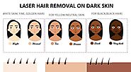 Laser Hair Removal For People With Dark Skin