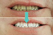 Professional vs. At-Home Teeth Whitening