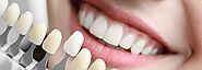 Longevity of Teeth Whitening