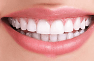 Touch Up Teeth Whitening Treatment - Pro Glow Teeth Whitening