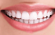 The Ultimate Guide to Teeth Whitening Services in Toronto