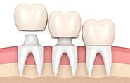 Dental Crowns in Abu Dhabi | Best Dental Crown Treatment