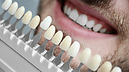 Rediscovering Your Smile with Dental Veneers