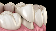 Advantages of Porcelain Crowns for Your Smile Makeover