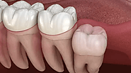 What is the Recovery Time after Wisdom Teeth Removal?