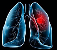 Best Hospitals for Lung Cancer Treatment in Delhi