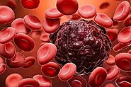 Choosing the Right Blood Cancer Treatment Center in Delhi - oncare cancer