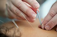 Can Acupuncture Help with Anxiety