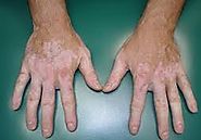 Pictures of vitiligo skin condition