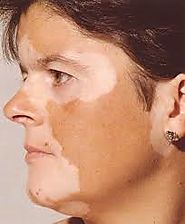 Vitiligo skin patches pictures