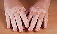 Overview of vitiligo and its managements