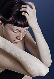 Vitiligo skin cancer