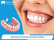 [Nha khoa Shark giải đáp] Bọc răng sứ có cắt lợi được không?