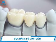 Bọc răng sứ dính liền