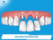 Có nên làm cầu răng sứ răng cửa