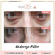 Dark Circles Treatment In Dubai, UAE