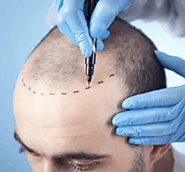 Hair Transplantation Clinic in Dubai, UAE | Skinezperts