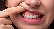 Symptoms of Gum Disease: Don't Ignore the Warning Signs