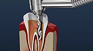 How Long Does a Root Canal Take: Demystifying the Process