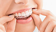 Invisalign Dentist vs. Orthodontist: Which One Should I Use?