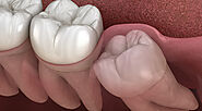 The Effect of Wisdom Teeth Removal on Oral Health and Overall Well-Being