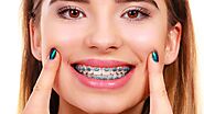Top Things to Know Before Getting Braces in Boca Raton