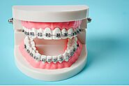 Essential Tips for Maintaining Braces For Oral Hygiene| Wyatt Orthodontics