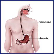 Is cancer of the esophagus curable?