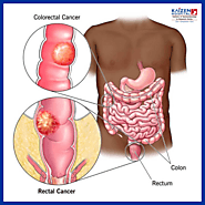 symptoms of rectal cancer