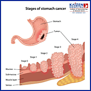What are 3 symptoms of stomach cancer?