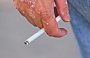 Smoking And Wound Healing - Are They Linked?