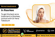 Best Acne Treatment in Roorkee, Doctors for Acne Treatment - Dermatologist in Roorkee