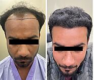 Hair Transplant In Roorkee - Best Hair Transplant Clinic in Roorkee