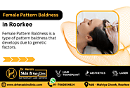 Female Pattern Baldness Treatment in Roorkee