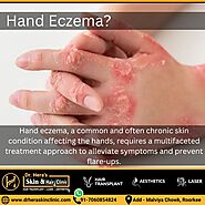 Hand eczema treatment