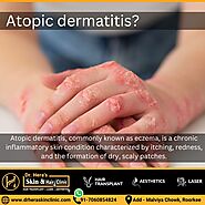 Atopic dermatitis treatments - Dermatologist in Roorkee