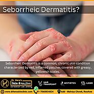 Seborrheic Dermatitis Treatment