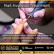 Nail Avulsion Treatment in Roorkee