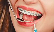 6 Braces Cleaning Tips for Healthy Teeth & a Bright Smile