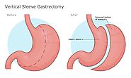 Gastric Sleeve Surgery