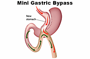 Mini Gastric Bypass