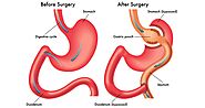 gastric bypass surgery