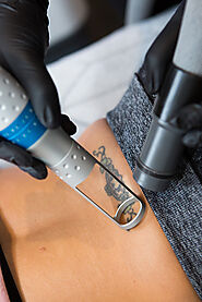 Tattoo Removal Phoenix Arizona | Vivid Skin & Laser Center