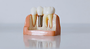 5 Ways to Choose the Right Dental Implant Specialist