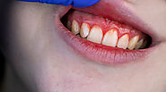 Why Regular Dental Checkups are Crucial for Preventing Gum Disease?